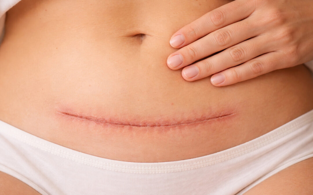 Die Kaiserschnitt-Narbe