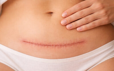 Die Kaiserschnitt-Narbe